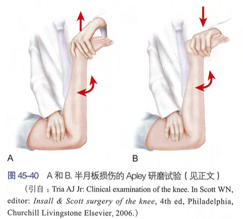 麦氏征(mcmurrys test)检查大多数为阳性,可进行定位,是最常用的检查