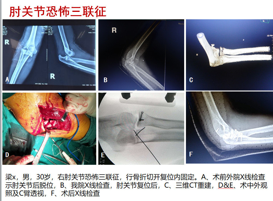 8203肘关节恐怖三联征