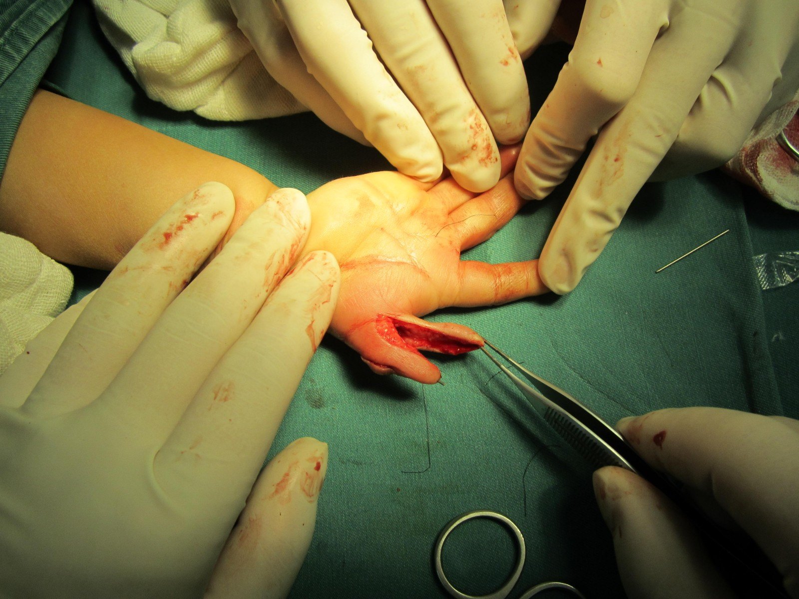 先天性拇指多指畸形(复拇指畸形)的矫正 - 好大夫在线