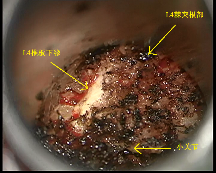 骨质表面剔除清楚后影像--图例.png