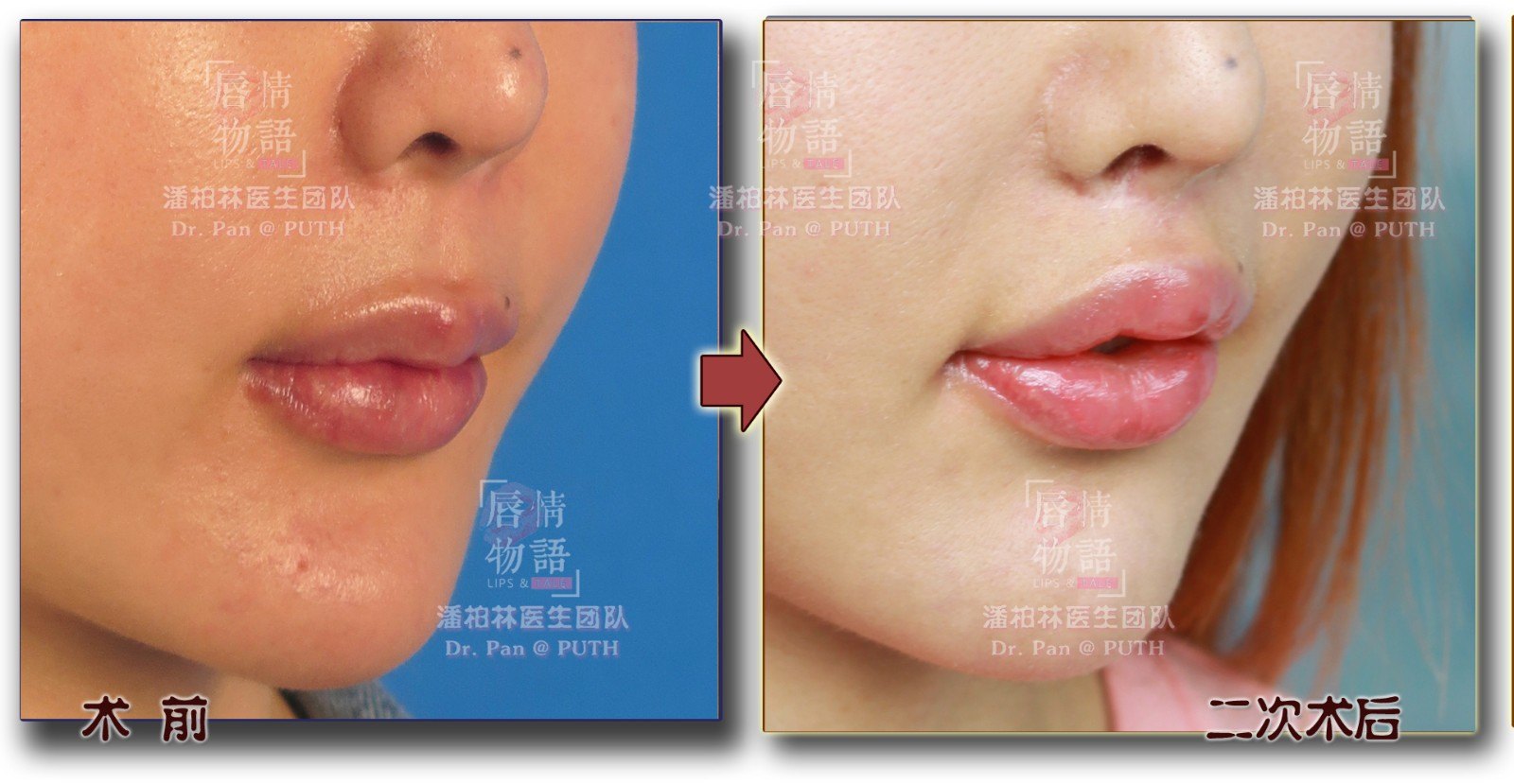 上唇人中缩短术upperliplift