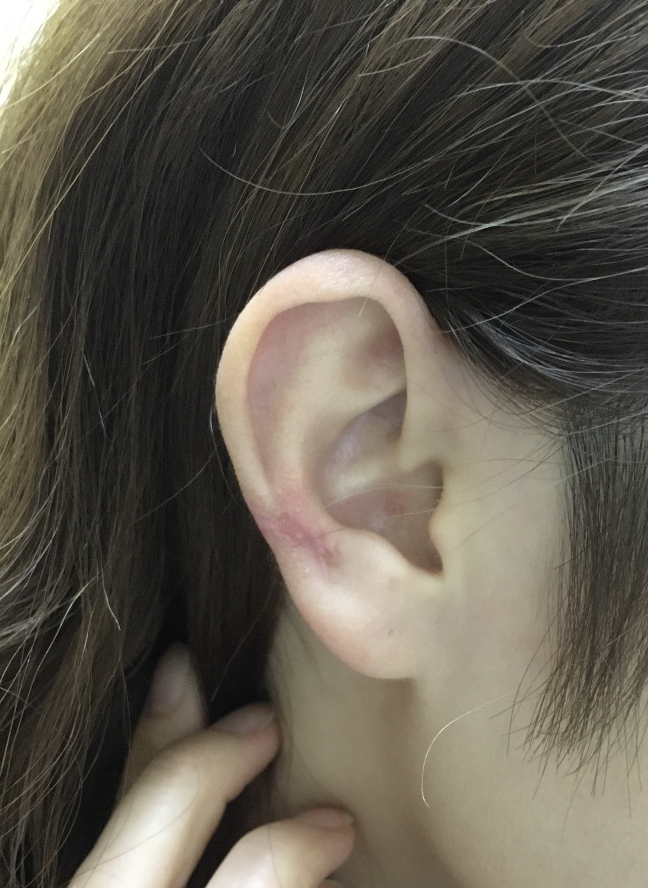 耳部瘢痕疙瘩图片图片