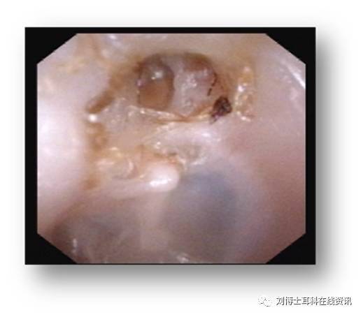 正常的鼓膜:鼓膜完整並且標誌清楚鼓膜穿孔根據部位分為緊張部穿孔和