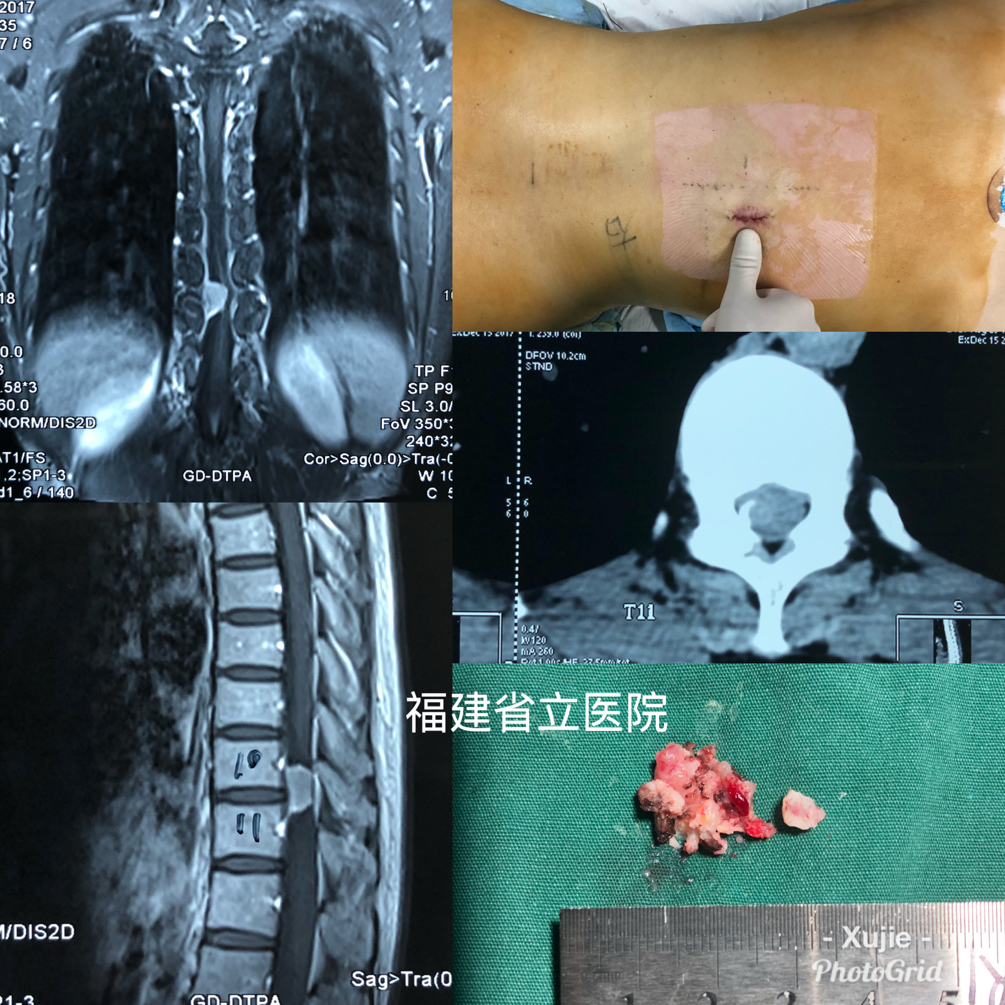 脊膜瘤手术成功率图片