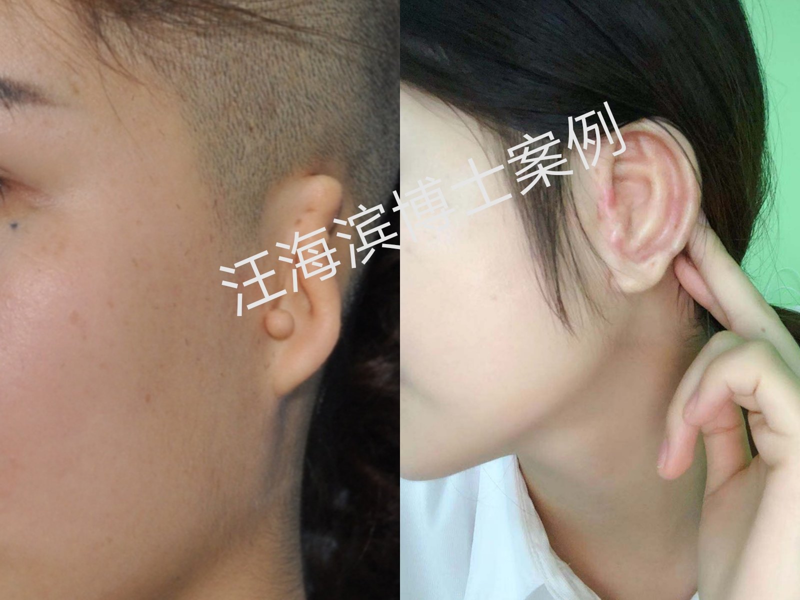 先天性小耳再造术前术后对比图 - 好大夫在线