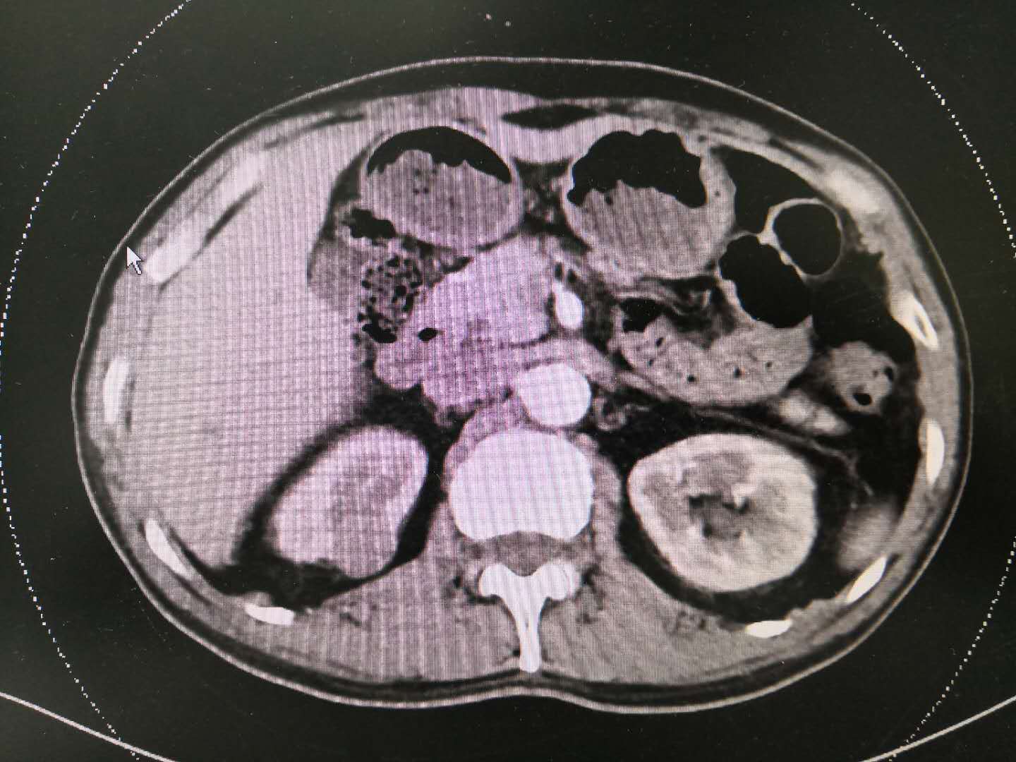 少見腎癌類型-乳頭狀癌2型--ct強化不明顯的腎腫瘤 - 好大夫在線