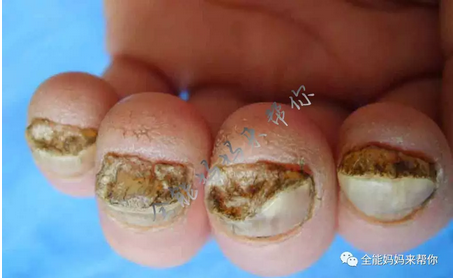 指甲有问题看这篇文章就够了
