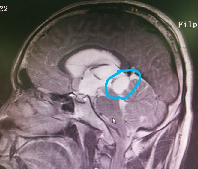案例神经内镜下一站式解决松果体区肿瘤合并脑积水 - 好大夫在线