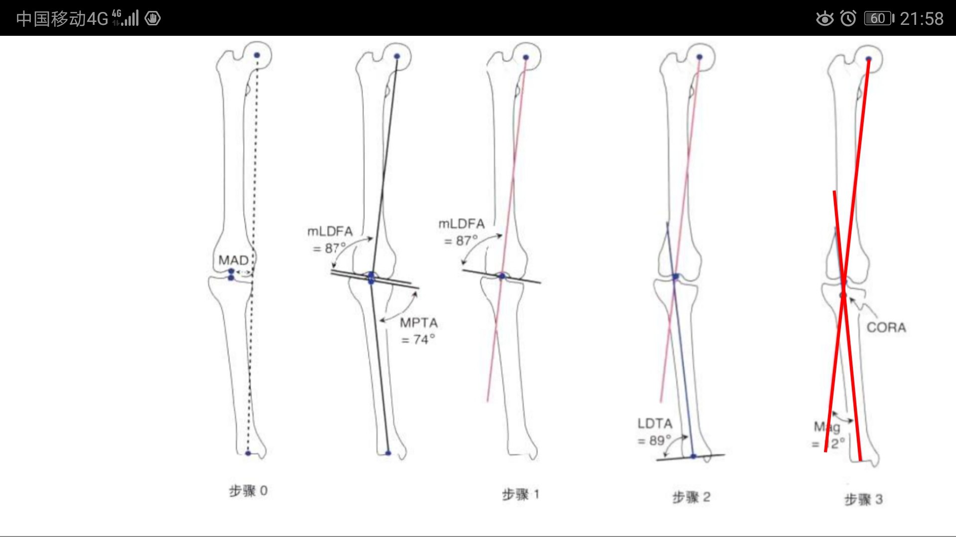 大转子滑移截骨图解图片