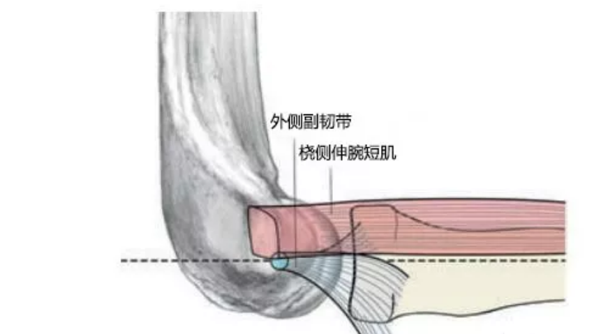 肌腱炎病世界的网球肘中国的主妇肘