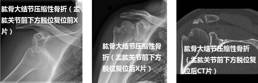 肩关节肱骨大结节骨折分成哪3种类型