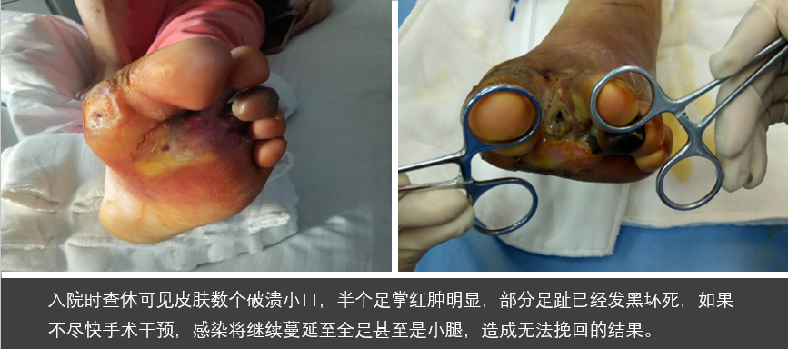 外科治疗一例糖尿病足的典型病例分享