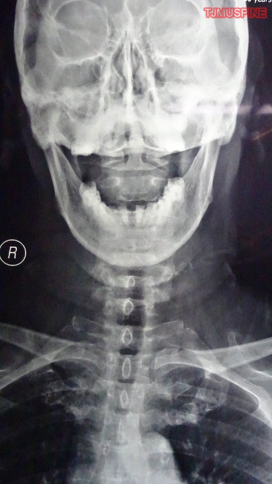 颈椎椎管狭窄 
