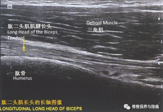 超声引导治疗肱二头肌肌腱炎 - 好大夫在线