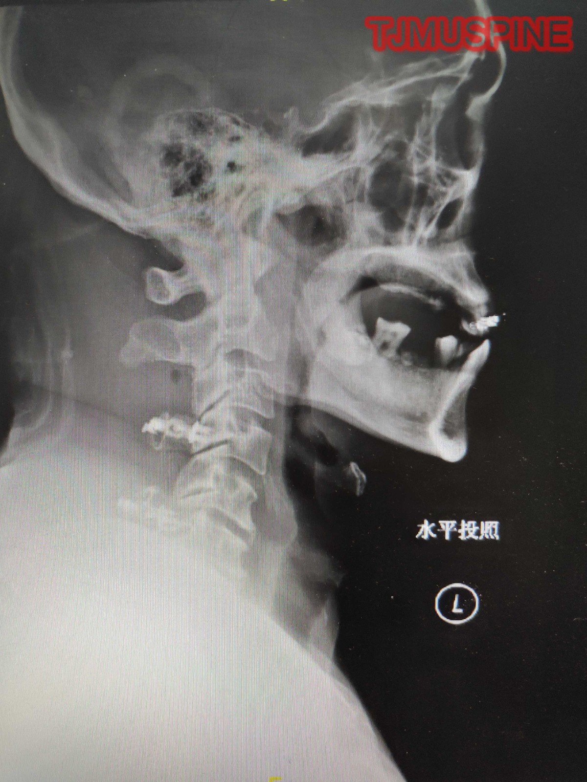 6椎板开门, 钛板,螺钉固定行c6门轴侧准备咬除c4,6椎板开门侧骨皮质