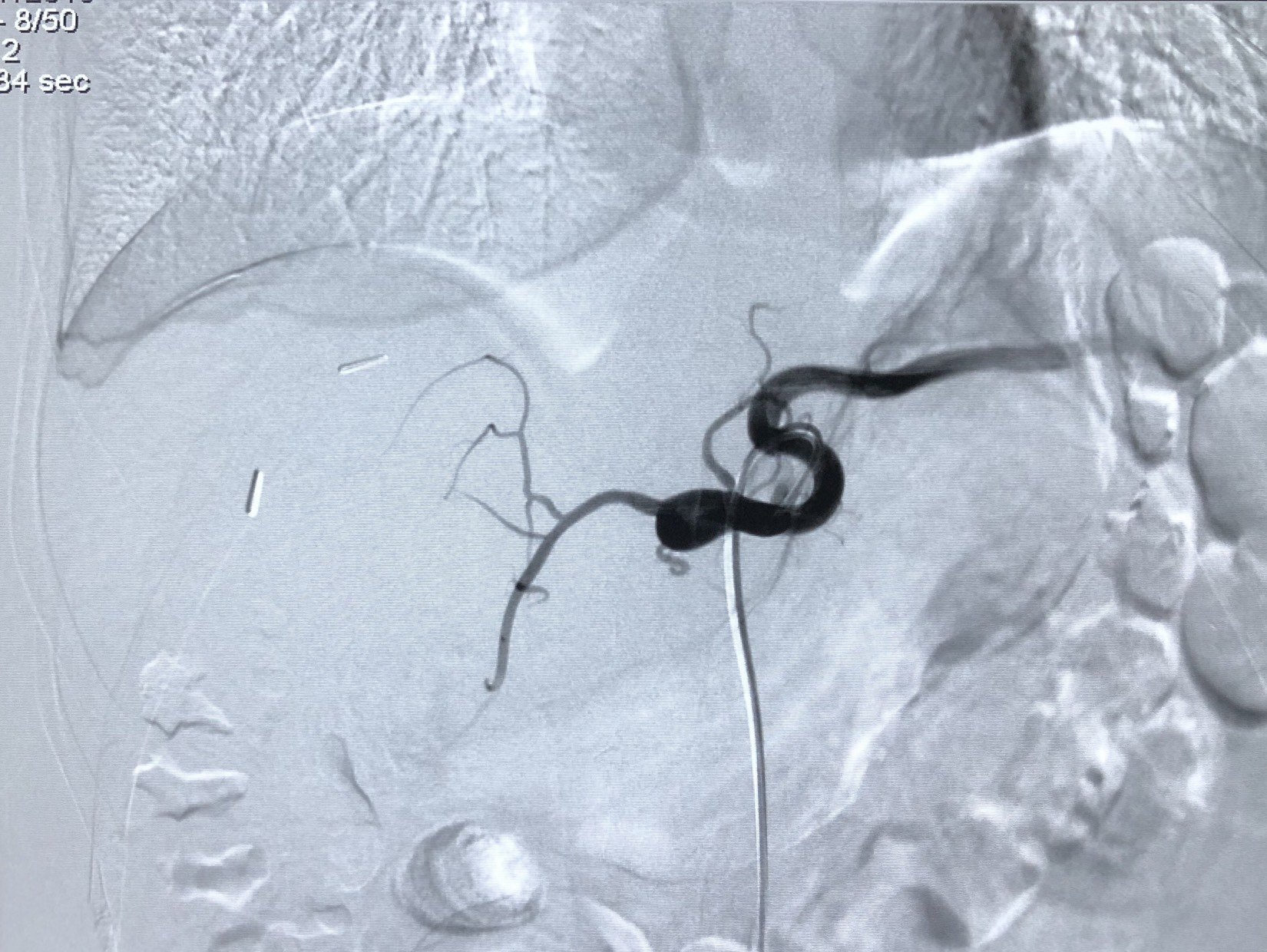 青年男性肝癌双肺多发转移,口服乐伐替尼后行tace治疗,造影见肝动脉