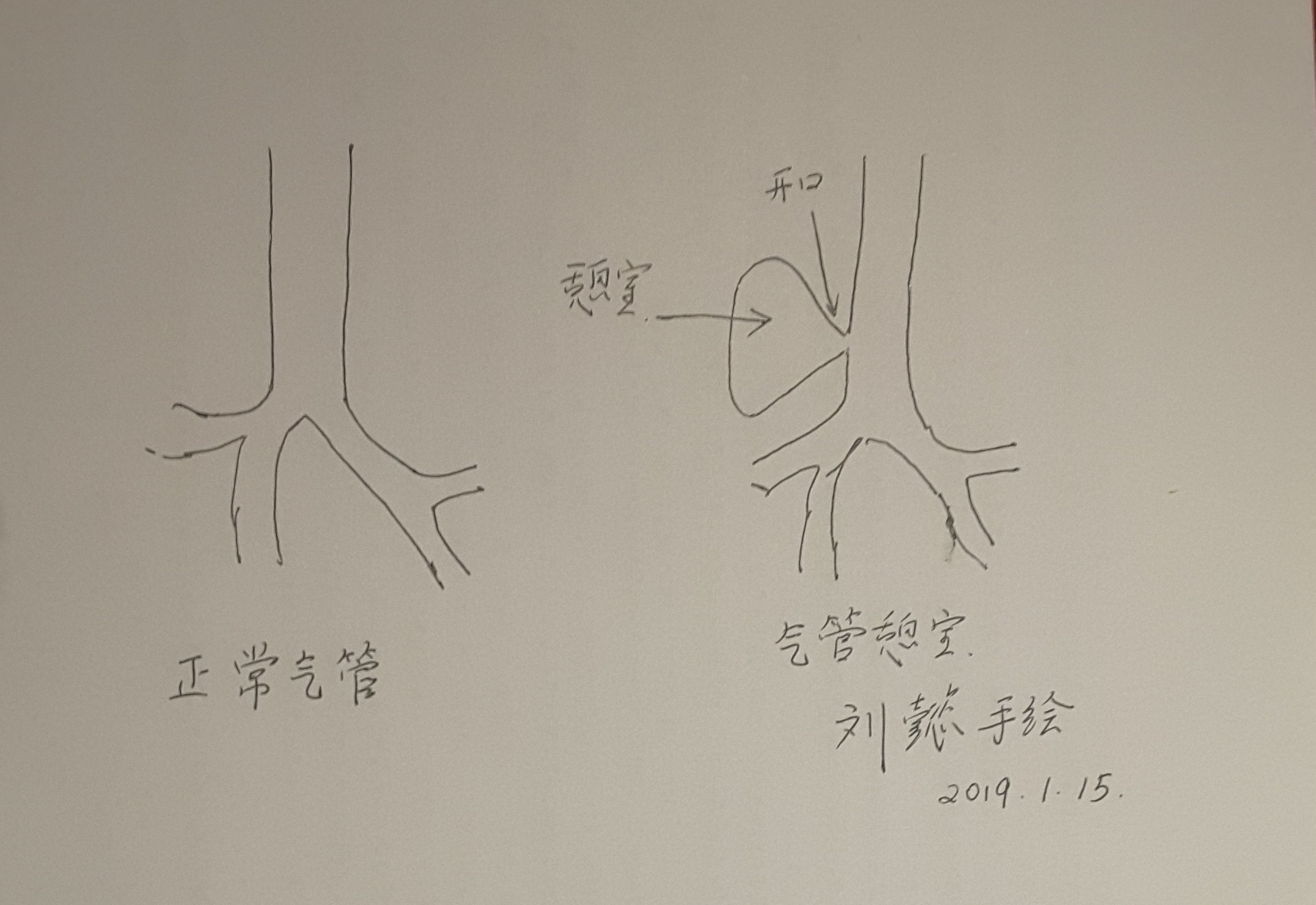 刘懿博士说肺癌七七九气管憩室是恶性疾病么需要做手术么