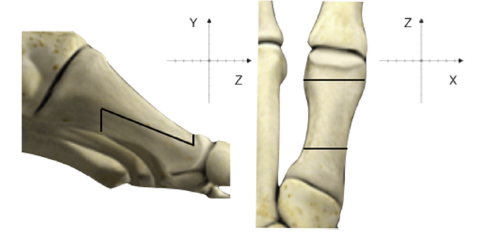 如何应用scarf截骨旋转第一跖骨及三维纠正踇外翻畸形? - 好大夫在线