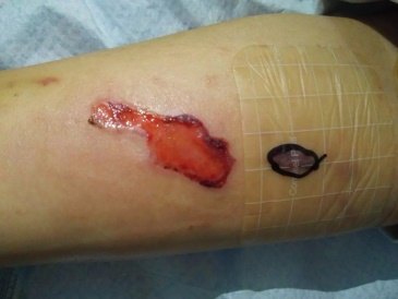 我科开展的肺癌相关治疗技术之一——静脉输液港植入手术(广州医科