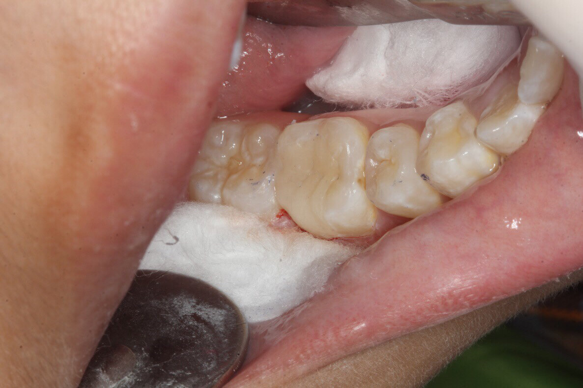 下面这个牙齿,是补牙密合度不良,一年后继发龋或容易脱落的表现