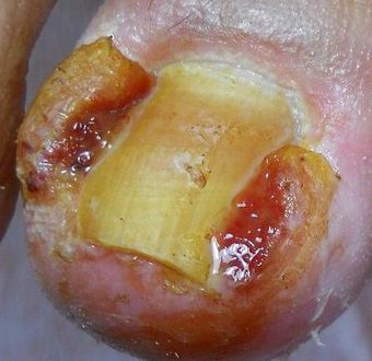 甲沟炎是什么原因产生的 uYYBAFyfZAiAGmhYAABUmQBirKs195.jpg?_ms_=e0db