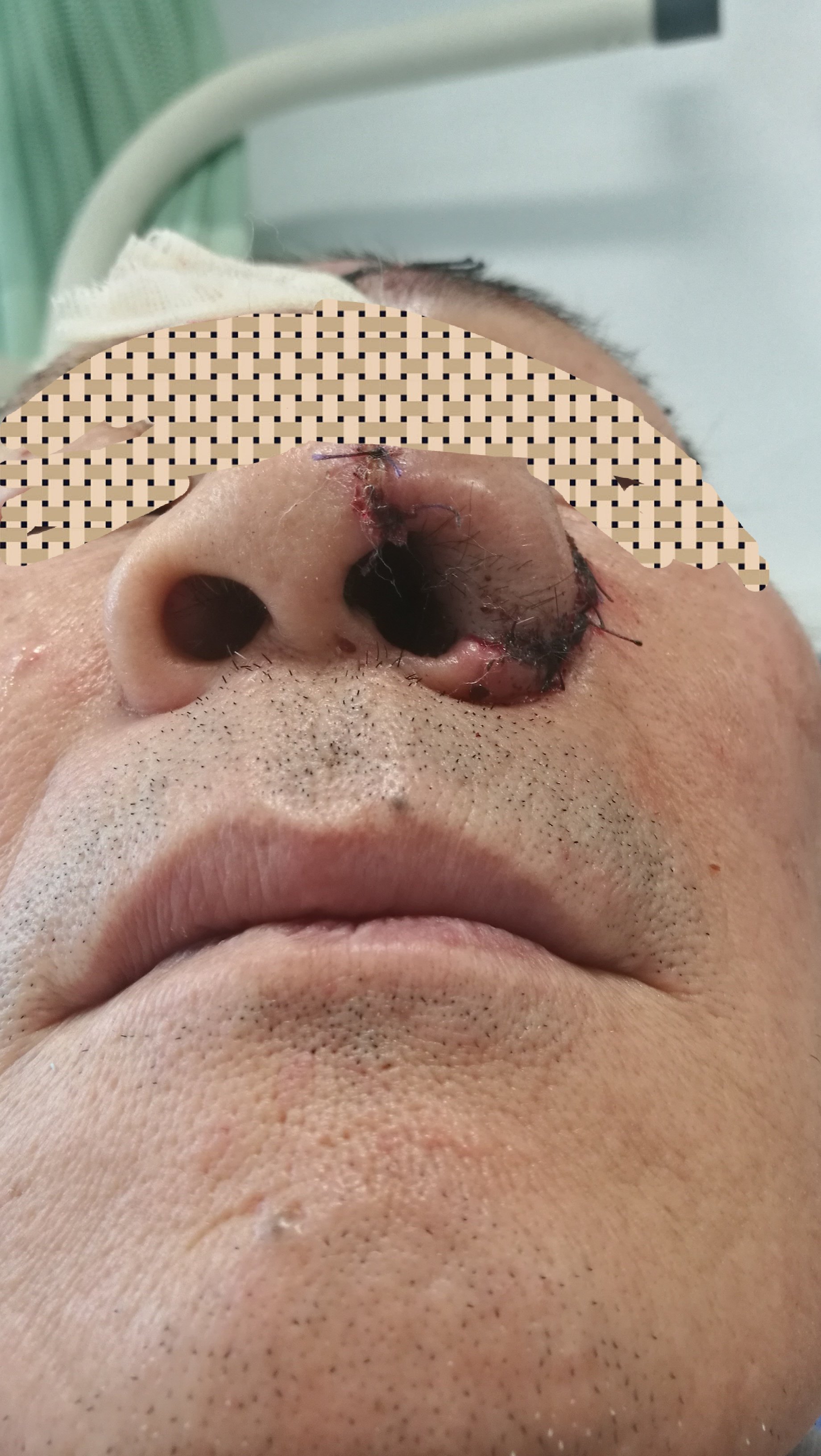 切除外鼻巨大肿瘤并外鼻重建(图)