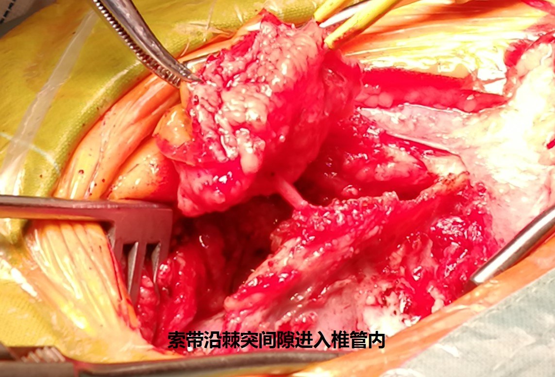 隐形脊柱裂,早发现,早治疗! - 好大夫在线