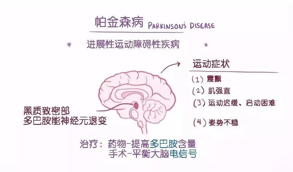 治疗帕金森百强医生全程相伴