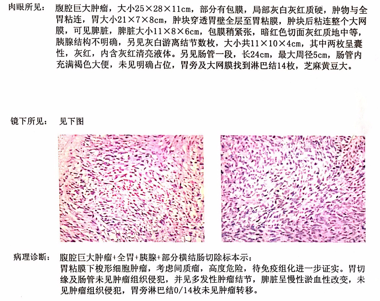 成功切除高龄超大胃间质瘤