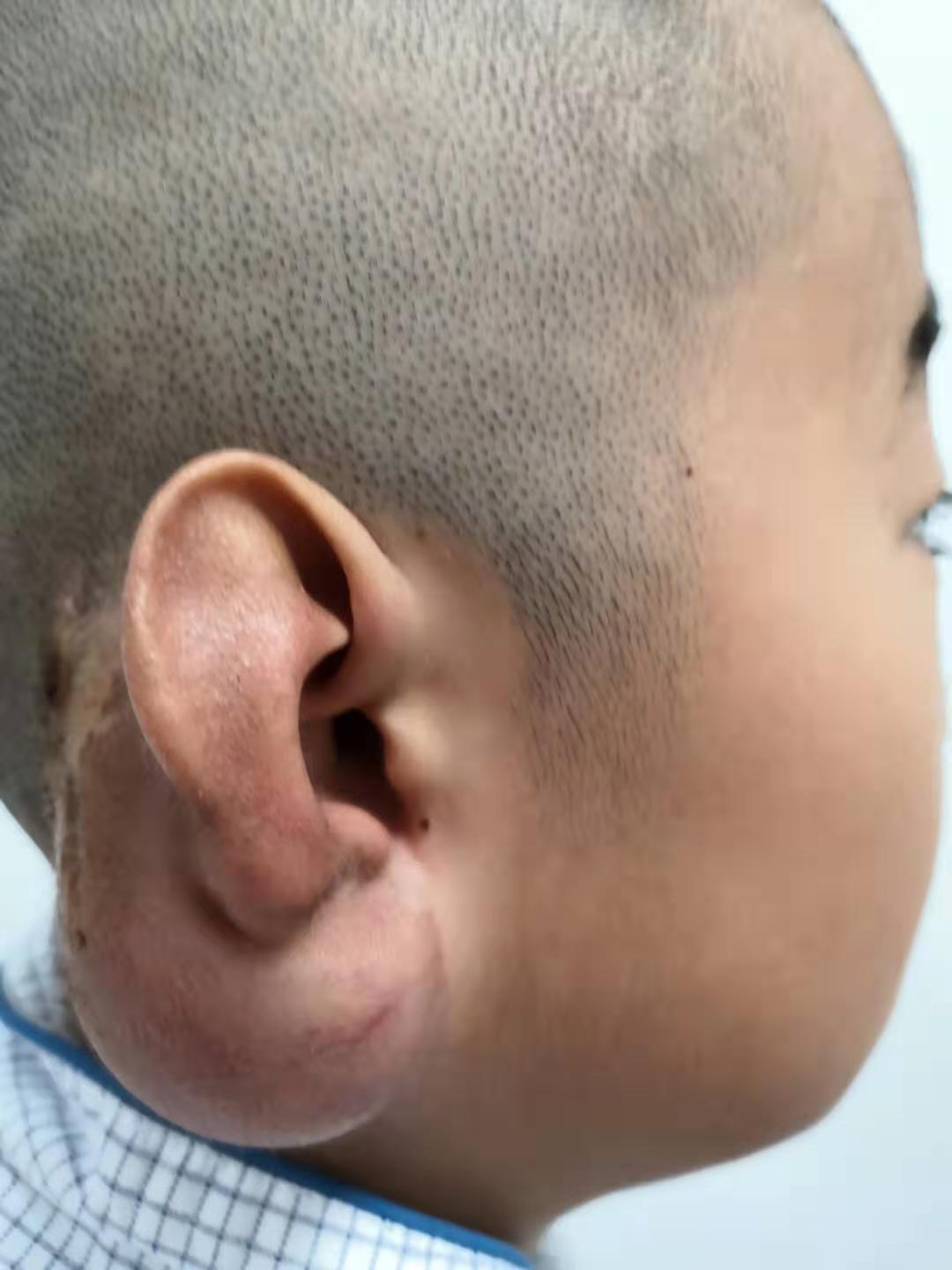 先天性耳下部分缺损(采用耳后皮肤扩张方法肋软骨支架移植) 