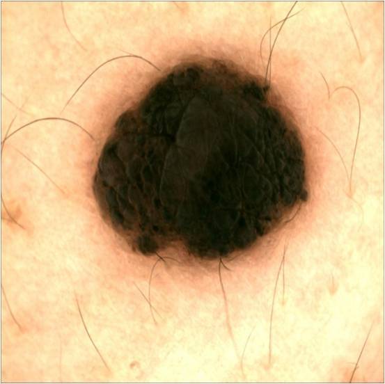 角化型鳞状细胞癌图片图片