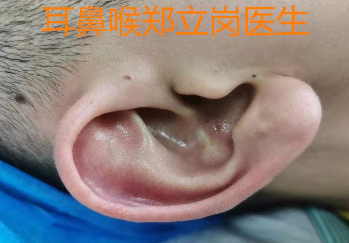 先天性耳前瘘管_先天性耳前瘘管能治好吗_先天性耳前瘘管会治愈吗