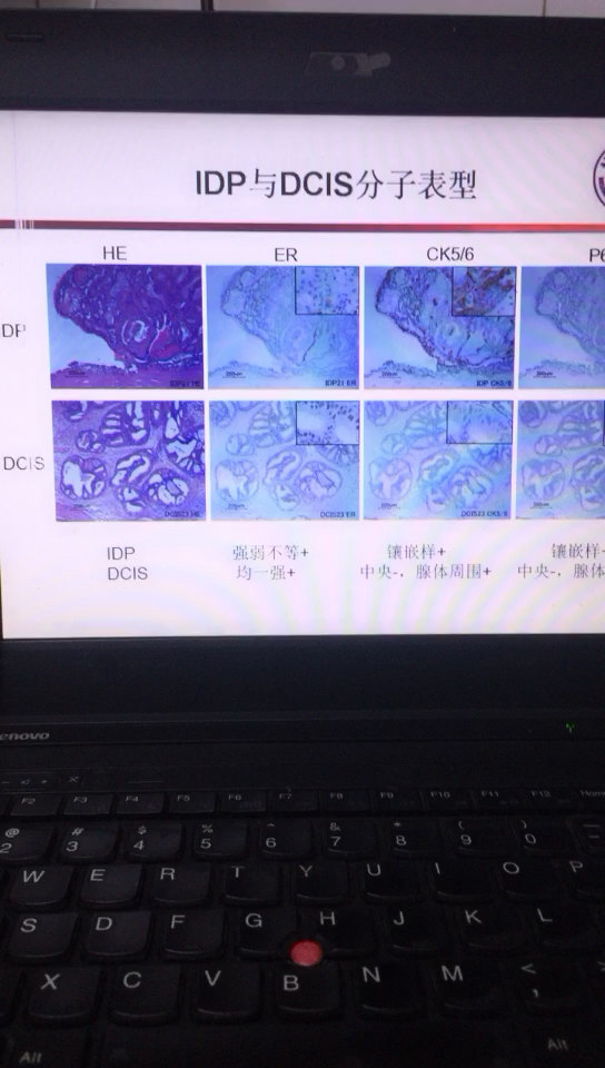 导管内乳头状肿瘤为什么一定要做免疫组化