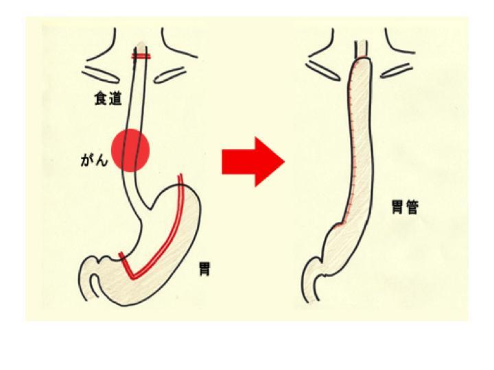 食管癌術式介紹:淋巴結三野清掃