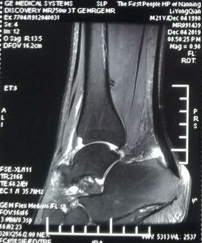 顽固性跟腱炎为什么治不好治疗方法没有选对