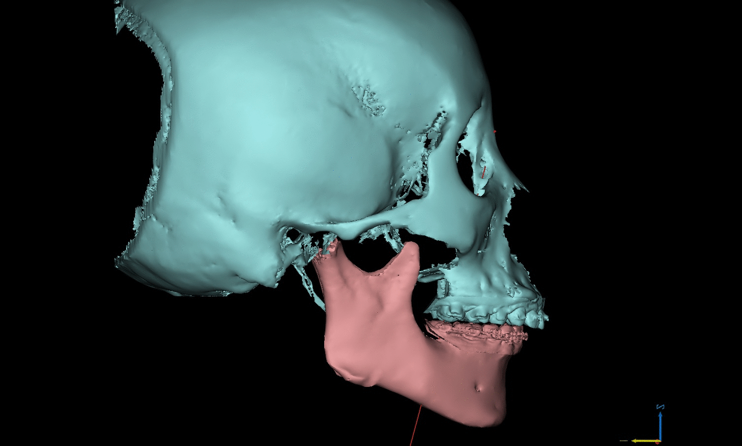对于单纯上颌前突,下颌突度较满意的病例,可以采取上颌前部截骨后退