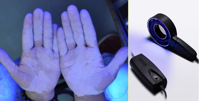 wood灯下的 !--haodf:8:baidianfeng-->白癜风 !