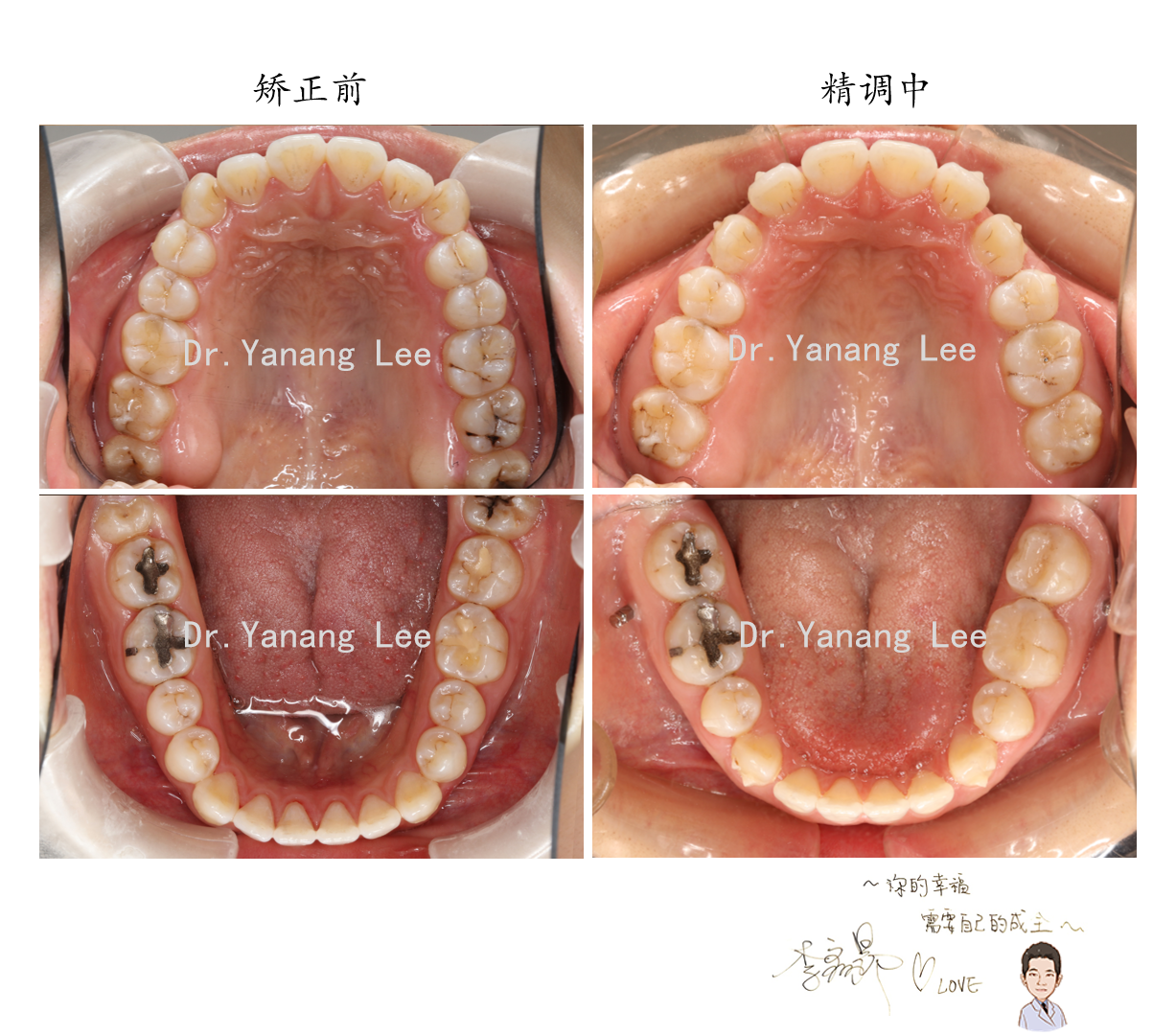 口內還有空間可以繼續內收一些,期待她的最終矯正效果!