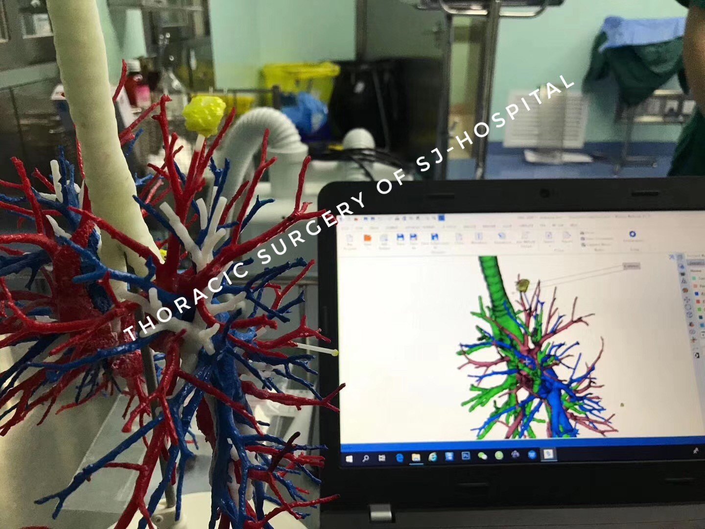 的早期肺癌都适合做亚肺叶切除(楔形切除,精准的肺段/肺亚段切除术)
