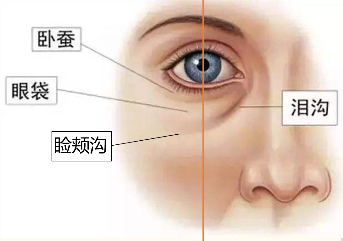 眼袋,卧蚕和泪沟,你能分清楚吗?