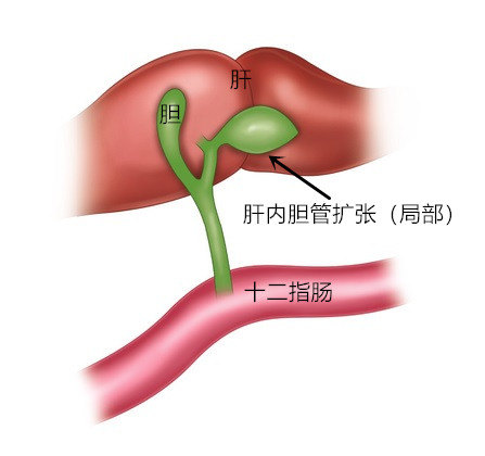 肝内胆管扩张图片