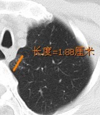 什么药能治肺结节最有效 u4YBAF5brtKAUgcsAABus3OgAo4080.jpg?_ms_=8730