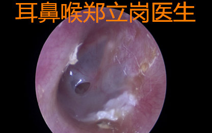 對於慢性化膿性中耳炎鼓膜小穿孔的患者,怎樣選擇手術的方式是一個