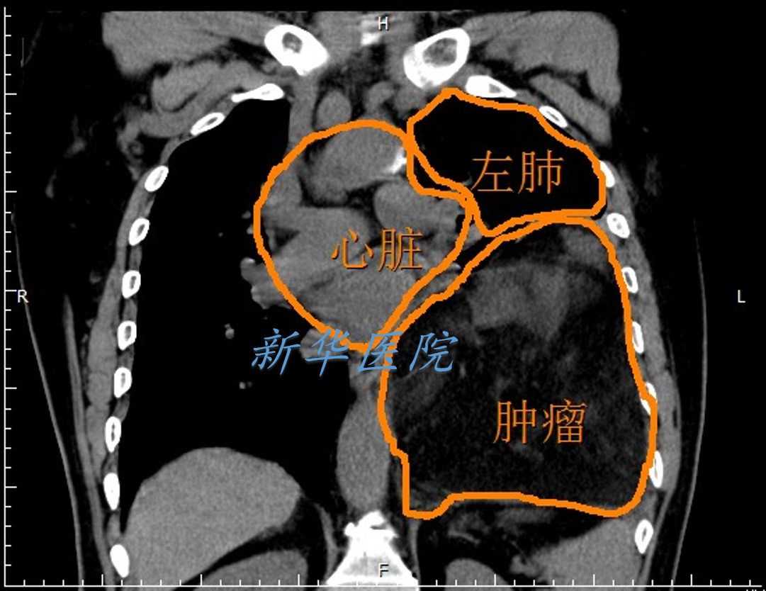 巨大纵隔肿瘤切除系列之一