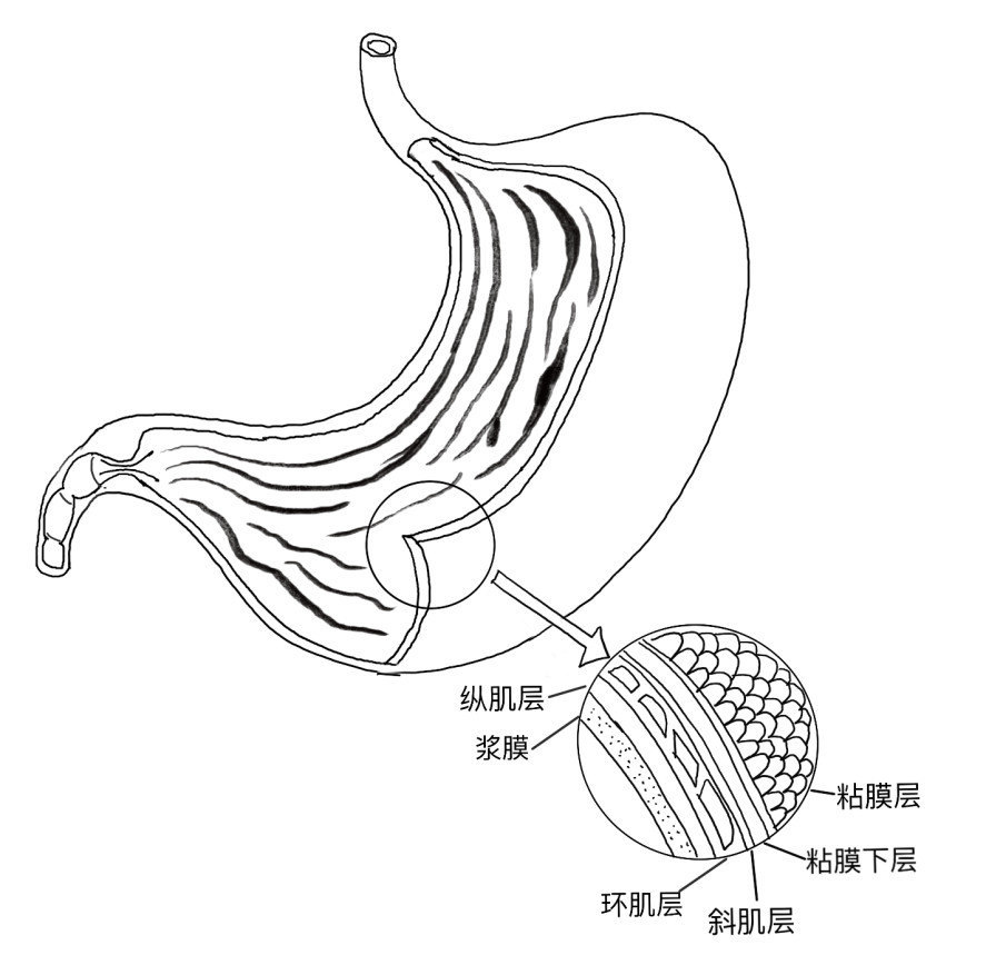 胃腺癌 手绘图片