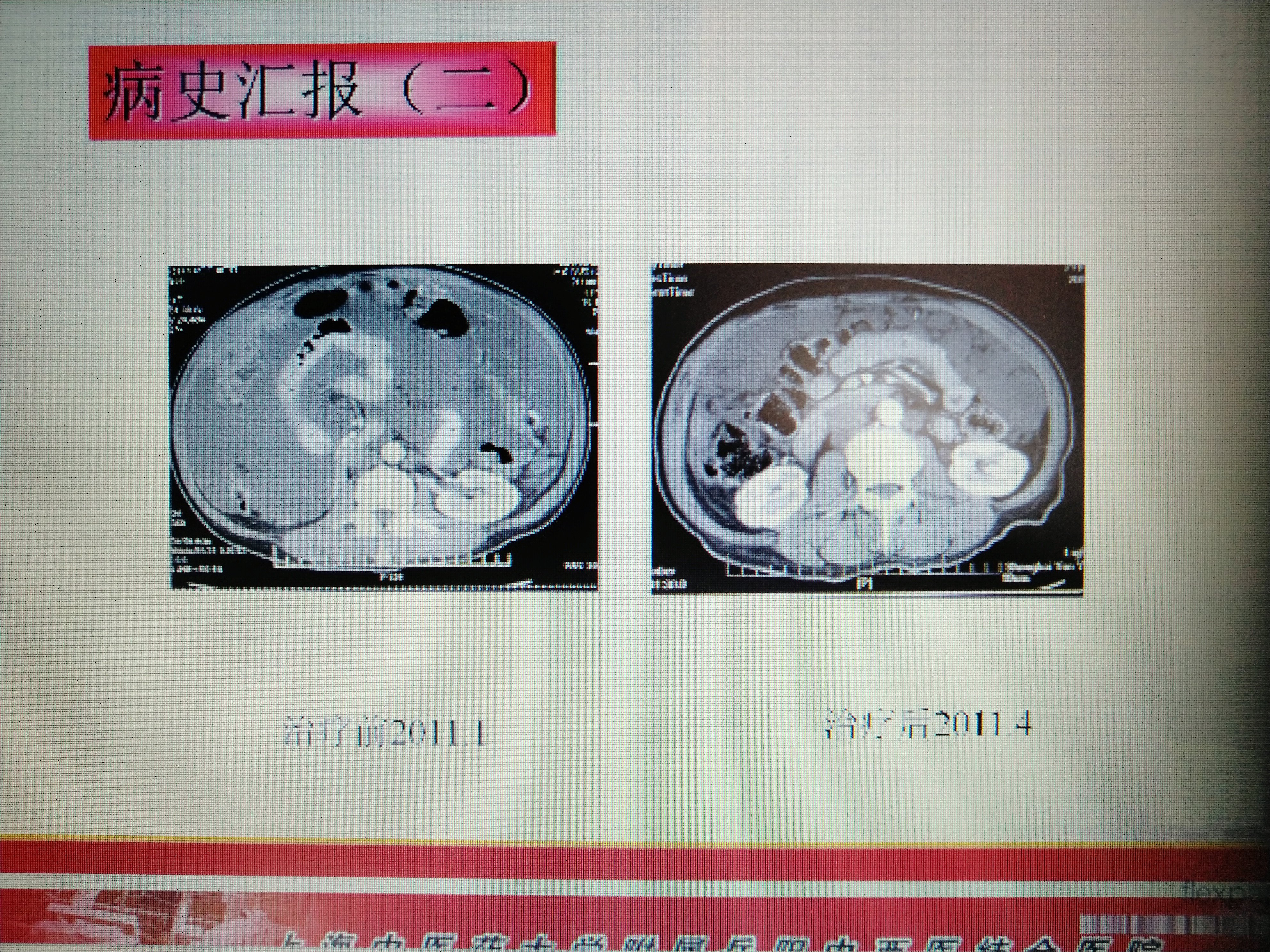 體腔溫熱灌注化療治療惡性腫瘤腹膜轉移惡性胸腹水效果好