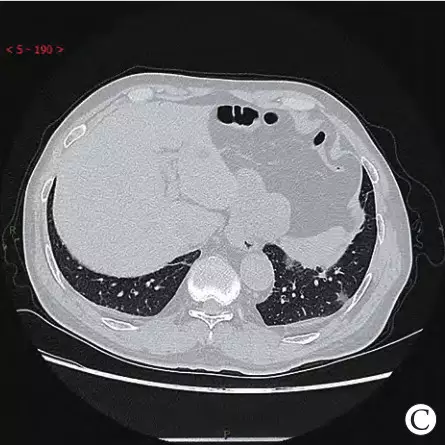 新冠肺炎的肺CT图片图片