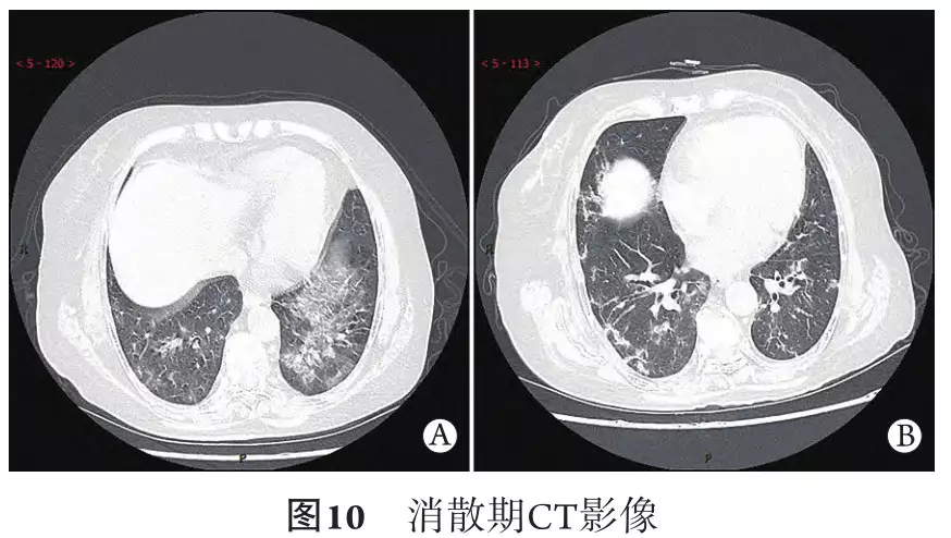 新冠肺炎典型ct表现 - 好大夫在线