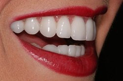 porcelain-veneers-after2.jpg