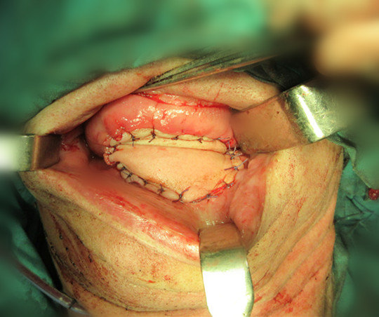 口咽癌图片图片